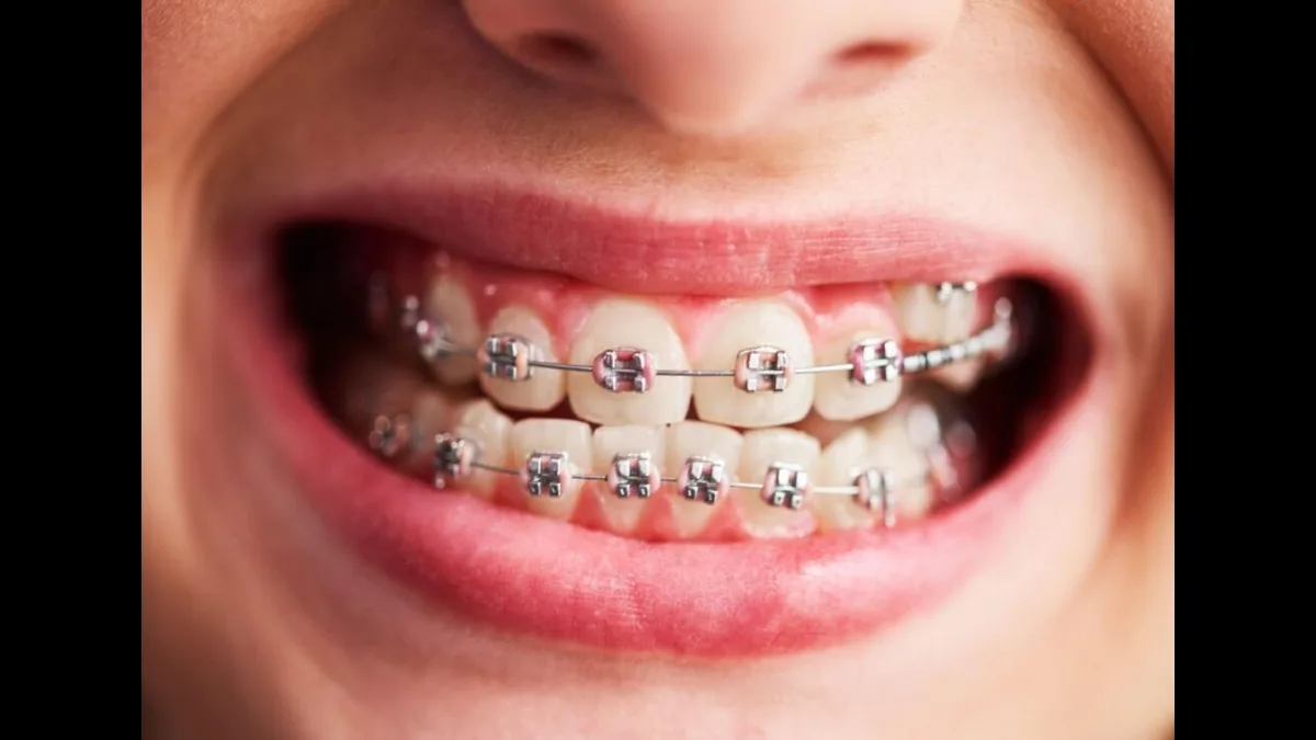 What Is Aesthetic Orthodontics And What Are Its Benefits?